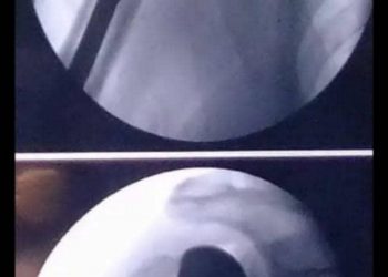 لاو مرة في السودان  إجراء عملية استبدال مفصل كتف بآخر صناعي