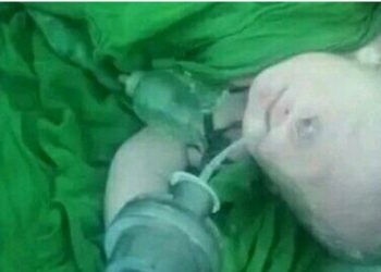 حالة ولادة نادرة لطفل بعين واحدة