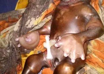 سبب استخدام المواد الكيمائية في التنقيب ولادة طفل مشوه بقرية في القضارف