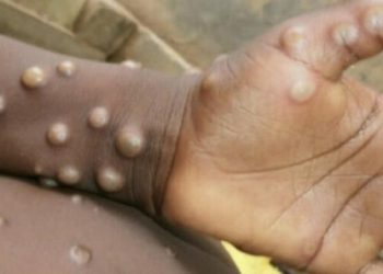 58 حالة وفاة بجدري القرود واجتماع طارئ لمنظمة الصحة العالمية