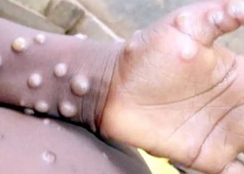 غرب دارفور تسجل 21حالة اشتباه بجدري القرود