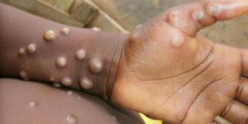 السودان ارتفاع عدد الإصابات بمرض جدري القرود الي  7