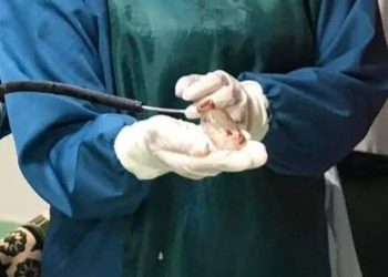 فريق طبي يتمكن من استخراج زجاجة دواء من بطن شاب