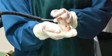 فريق طبي يتمكن من استخراج زجاجة دواء من بطن شاب