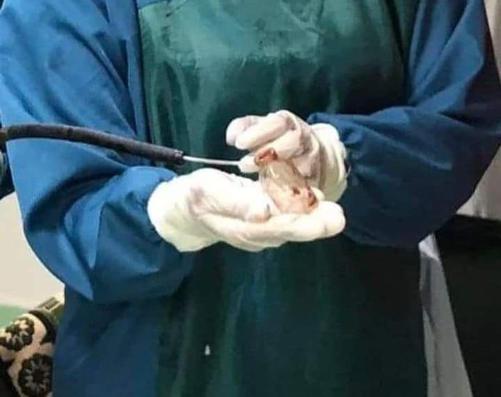 فريق طبي يتمكن من استخراج زجاجة دواء من بطن شاب