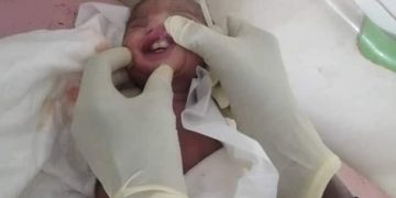حالة ولادة نادرة  لطفل باسنانه  بالسودان