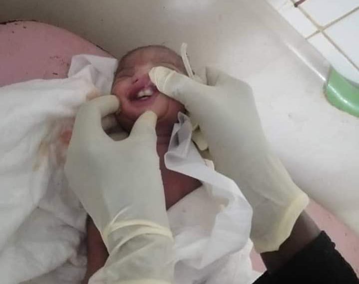 حالة ولادة نادرة  لطفل باسنانه  بالسودان